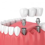 Health Benefits of Dental Bridges