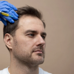 Hair Transplant in Turkey: The Ultimate Guide